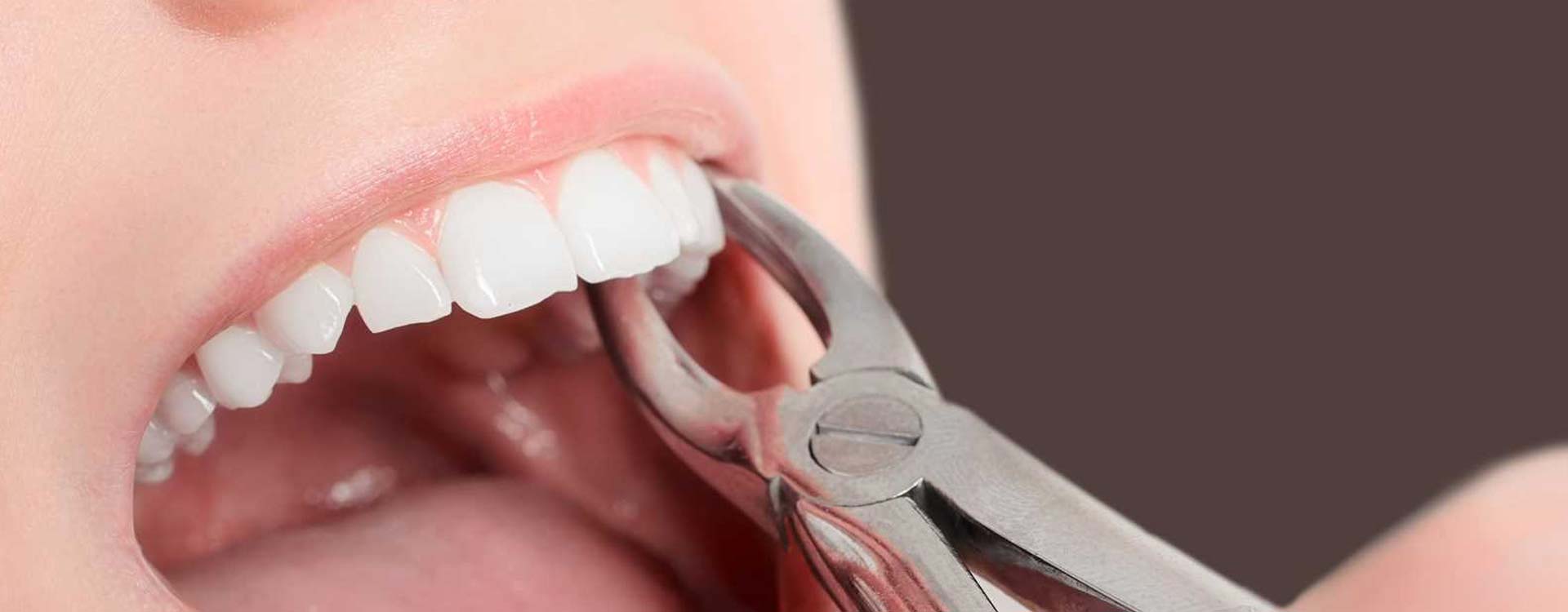 Extractia dentara chirurgicala