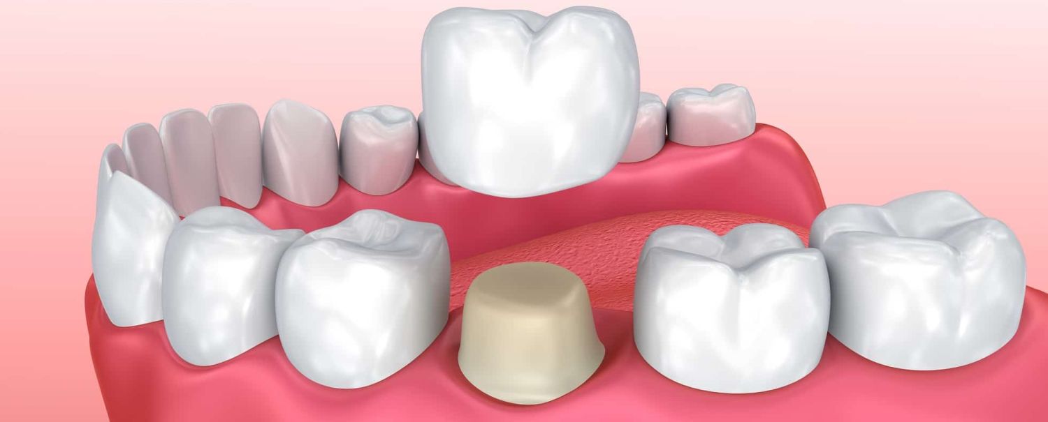 Insulate get annoyed Accumulation Coroana dentara din compozit | Dinti compozit | Dental Premier