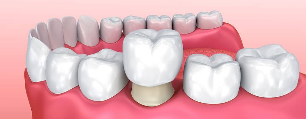 dentara integral ceramica: pret, dinti