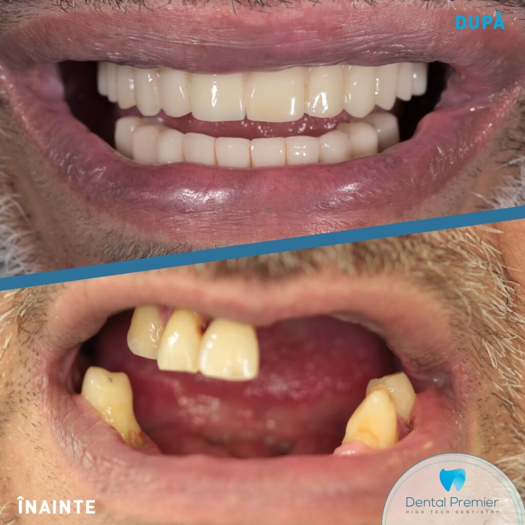 Implant subperiostal personalizat la maxilar + Fast and Fixed pe 4 implanturi la mandibula