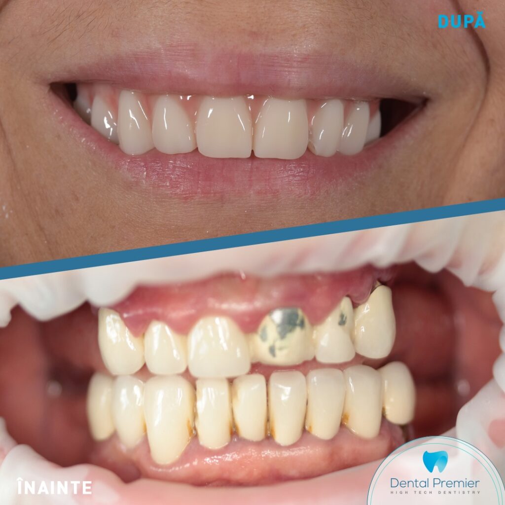Fast Smile Inno - maxilar 6 implanturi + lucrare fixa