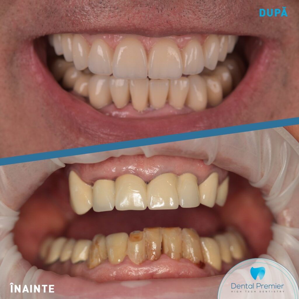 Maxilar - Lucrare fixa pe 8 implanturi + Mandibula - Retratamente
