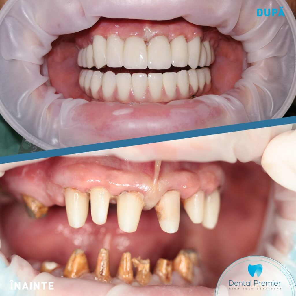 Restaurare dentara totala implanturi si dinti ficsi