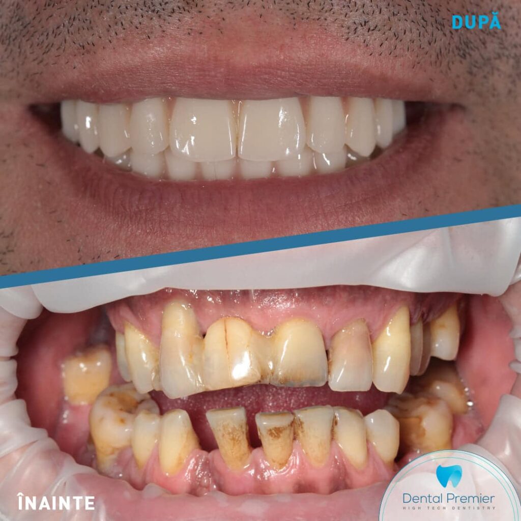 Implanturi All-on-4 Nobel Maxilar si Fast and Fixed Mandibula