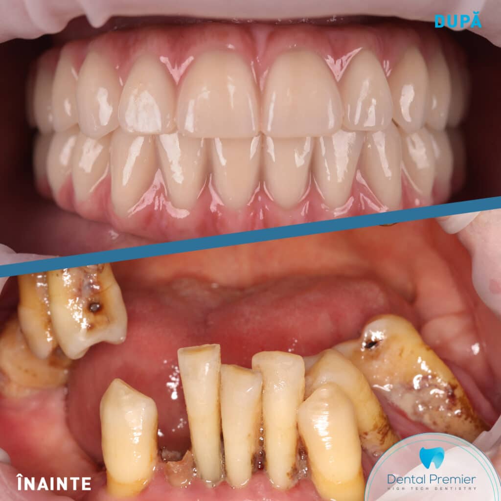 Reabilitare dentara totala cu implanturi All-on-4 si All-on-6