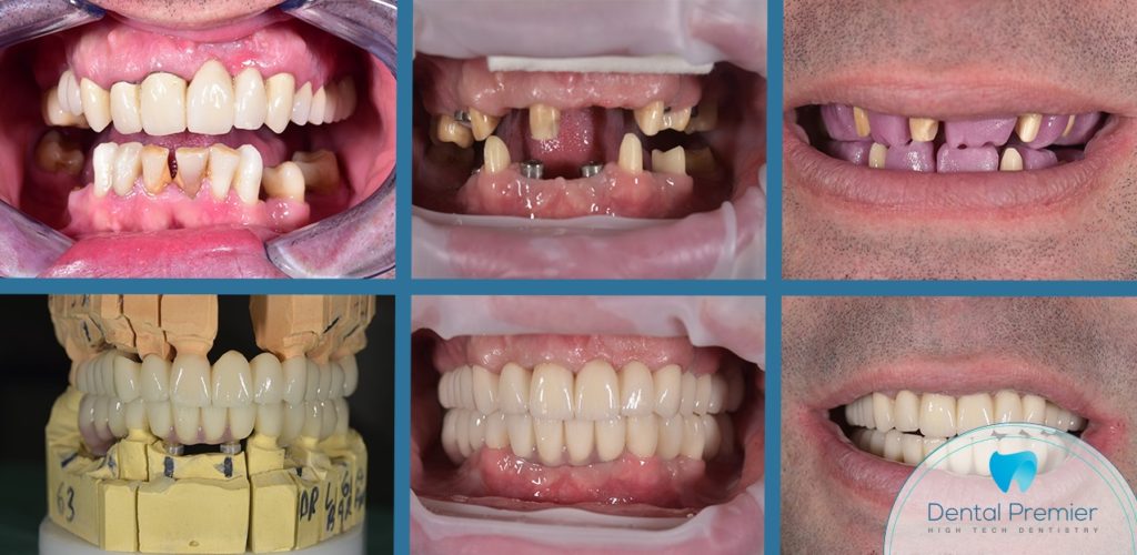 Coroane dentare integral ceramice - Estetica dentara avansata