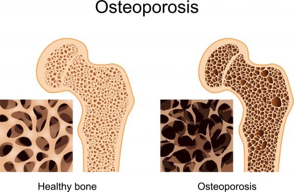 medici specialisti osteoporoza