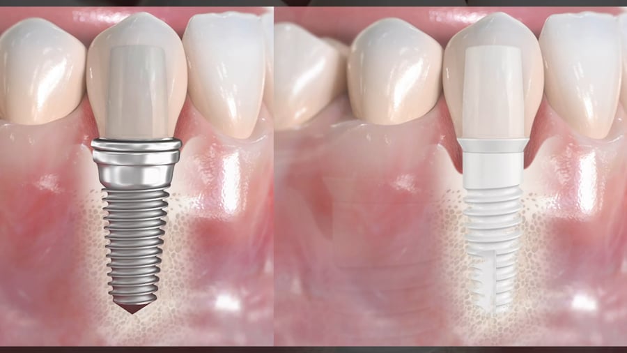 Implantul dentar din zirconiu/ceramic versus implantul dentar din titan