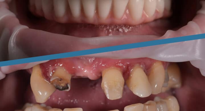 Practical acre Facet Protetica ✔️ Pret proteze, coroane si fatete dentare moderne