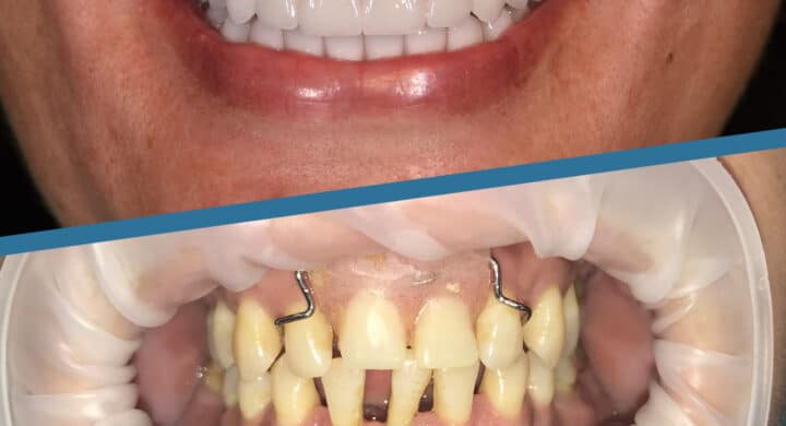 spade Mastermind Newness Proteza dentara fixa pe implanturi | Tehnologie Dental Premier