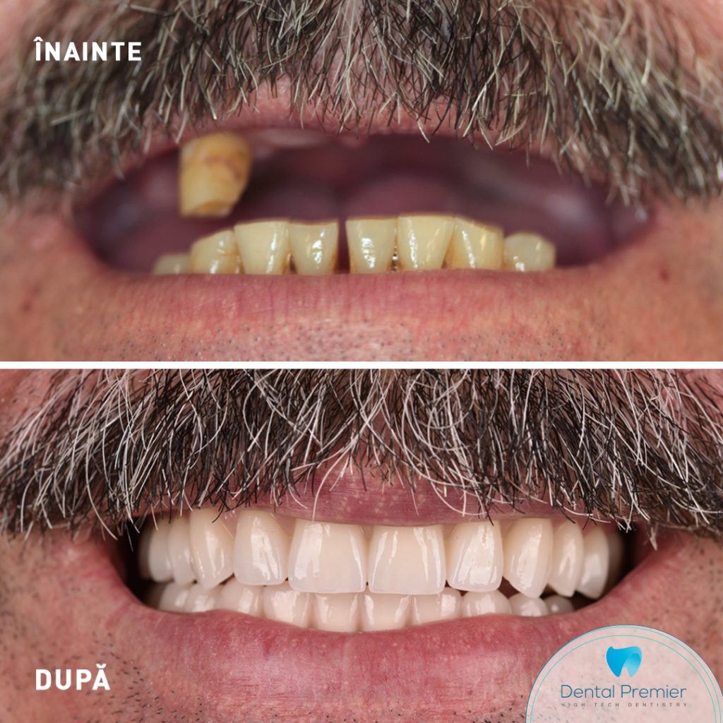 Implant dentar Fast and Fixed - Dinti ficsi pe sisteme All-on-4 si All-on-6