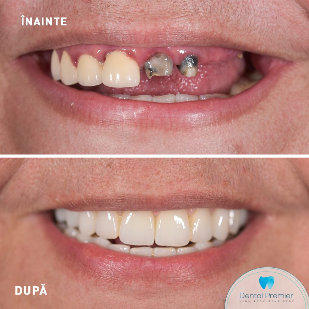 Pacienta dantura fixa pe implanturi in 24 ore - proteze fixe All-on-4 si All-on-6 la maxilar si mandibula