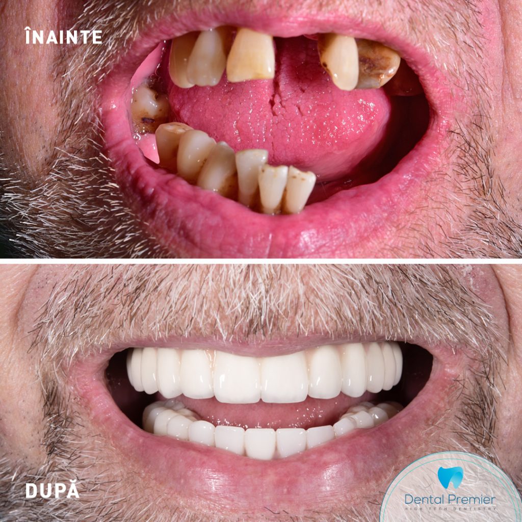 Pacient dinti ficsi pe implanturi in 24 ore - proteze fixe All-on-4 si All-on-6