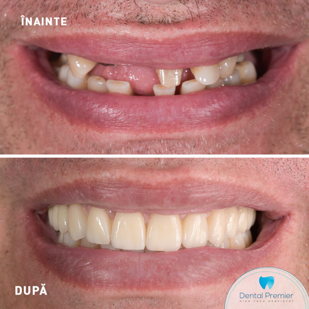 Pacient dantura fixa in 24 ore - proteze fixe cu 4 si 6 implanturi