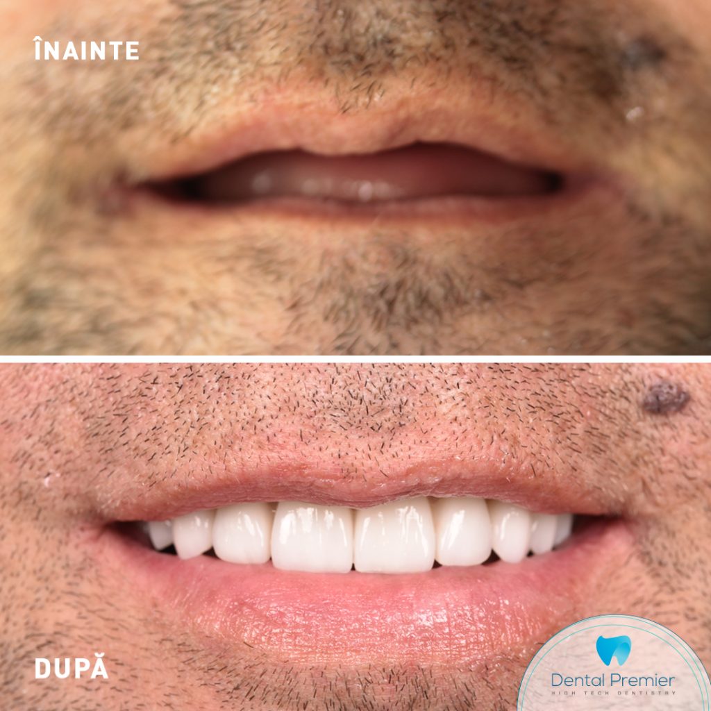 Fast and Fixed - implanturi si dinti ficsi in 24 ore cu implanturi Bredent All-on-4 si All-on-6