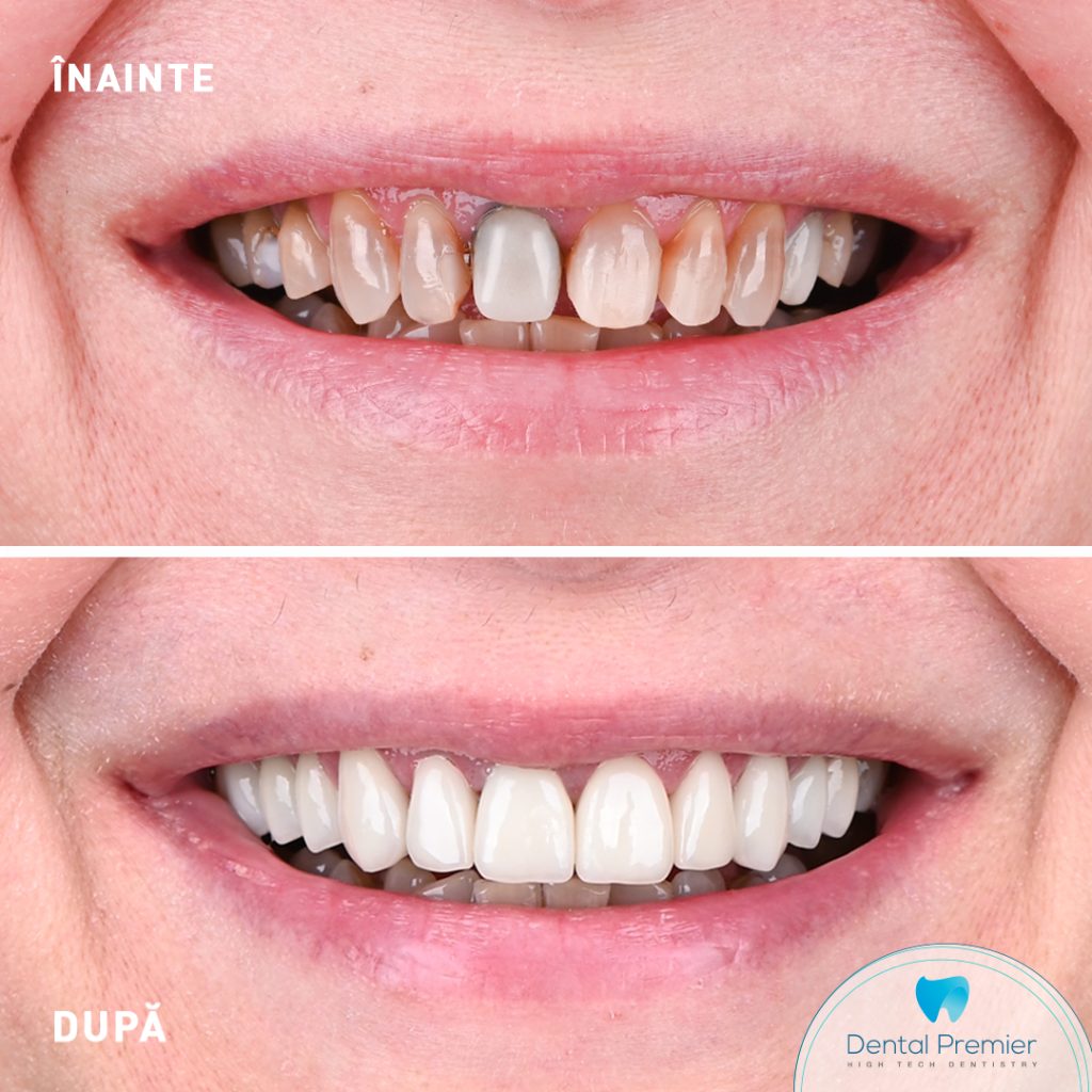 Dantura fixa in 24 de ore cu proteza dentara pe implanturi All-on-6 la arcada superioara