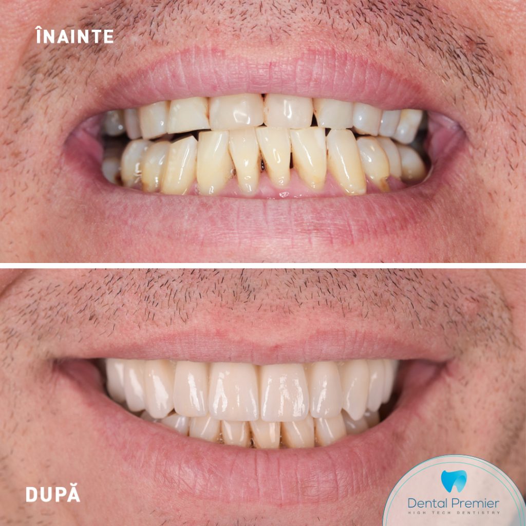 Dantura Fixa in 24 de ore cu proteze fixe pe implanturi All-on-6 si All-on-4 la Maxilar si Mandibula