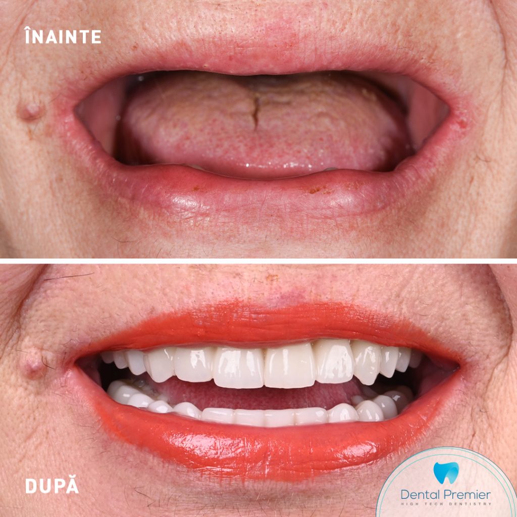 Dinti ficsi in 24 de ore cu proteze fixe pe implanturi All-on-4 si All-on-6 - Maxilar si mandibula