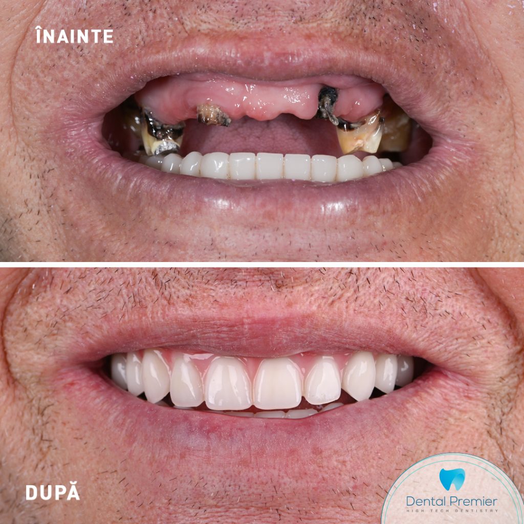 Dublu Restaurare Orala - cu implanturi si dinti ficsi in 24 ore - All-on-4 si All-on-6