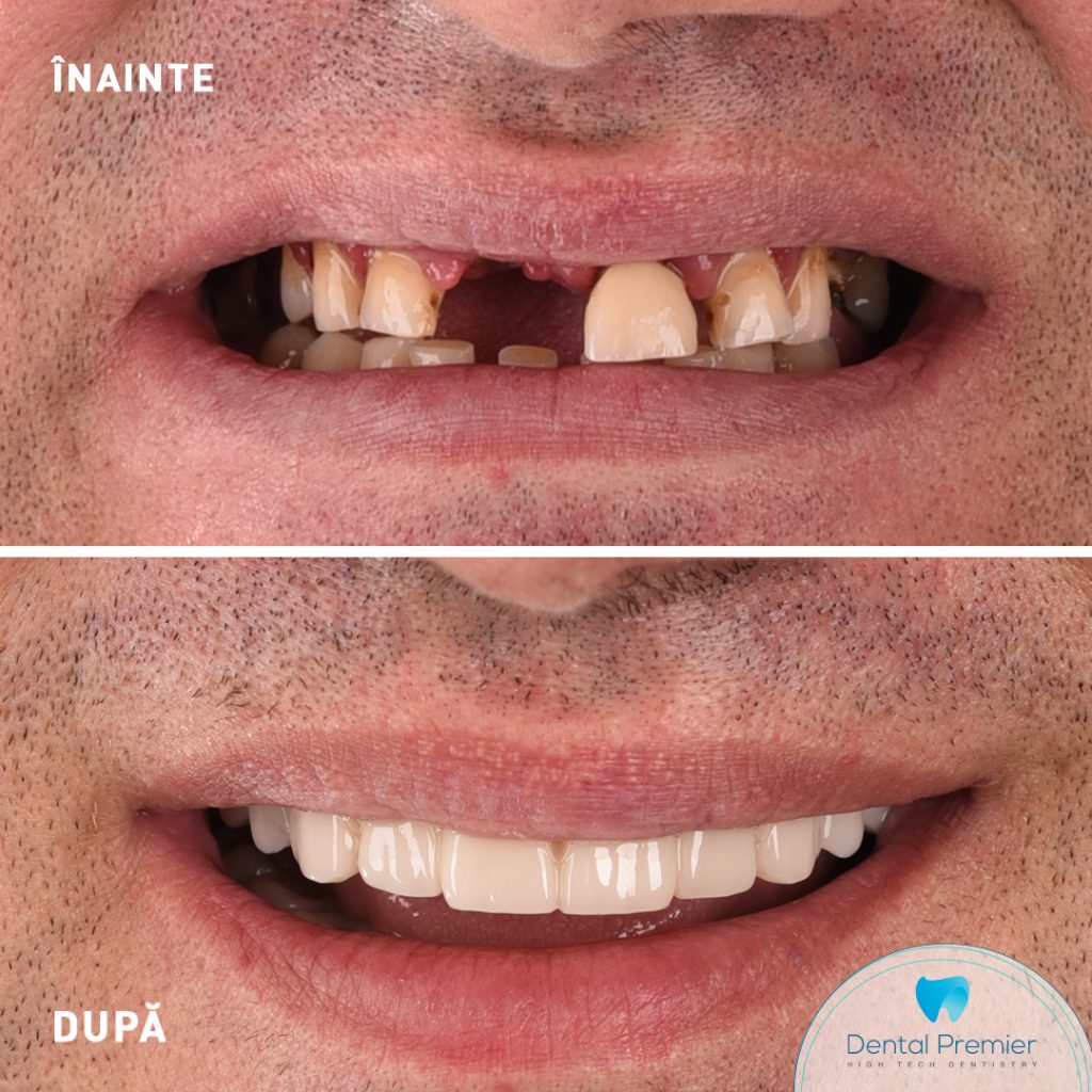 Restaurare totala bimaxilar - Implanturi All-on-6 &amp; All-on-4 + Dantura Fixa in 24 ore