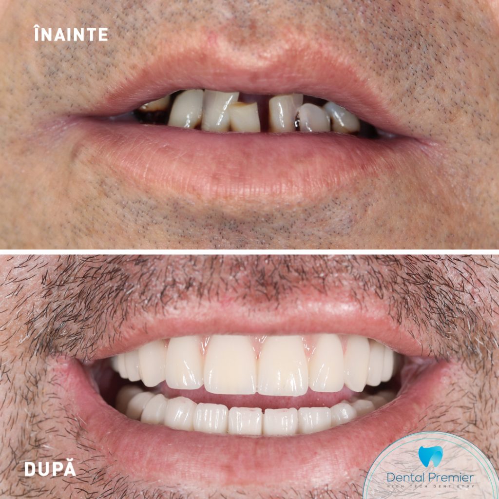 Dubla reabilitare orala - Implanturi dentare All-on-6 &amp; All-on-4 + Dinti Ficsi in 24 ore
