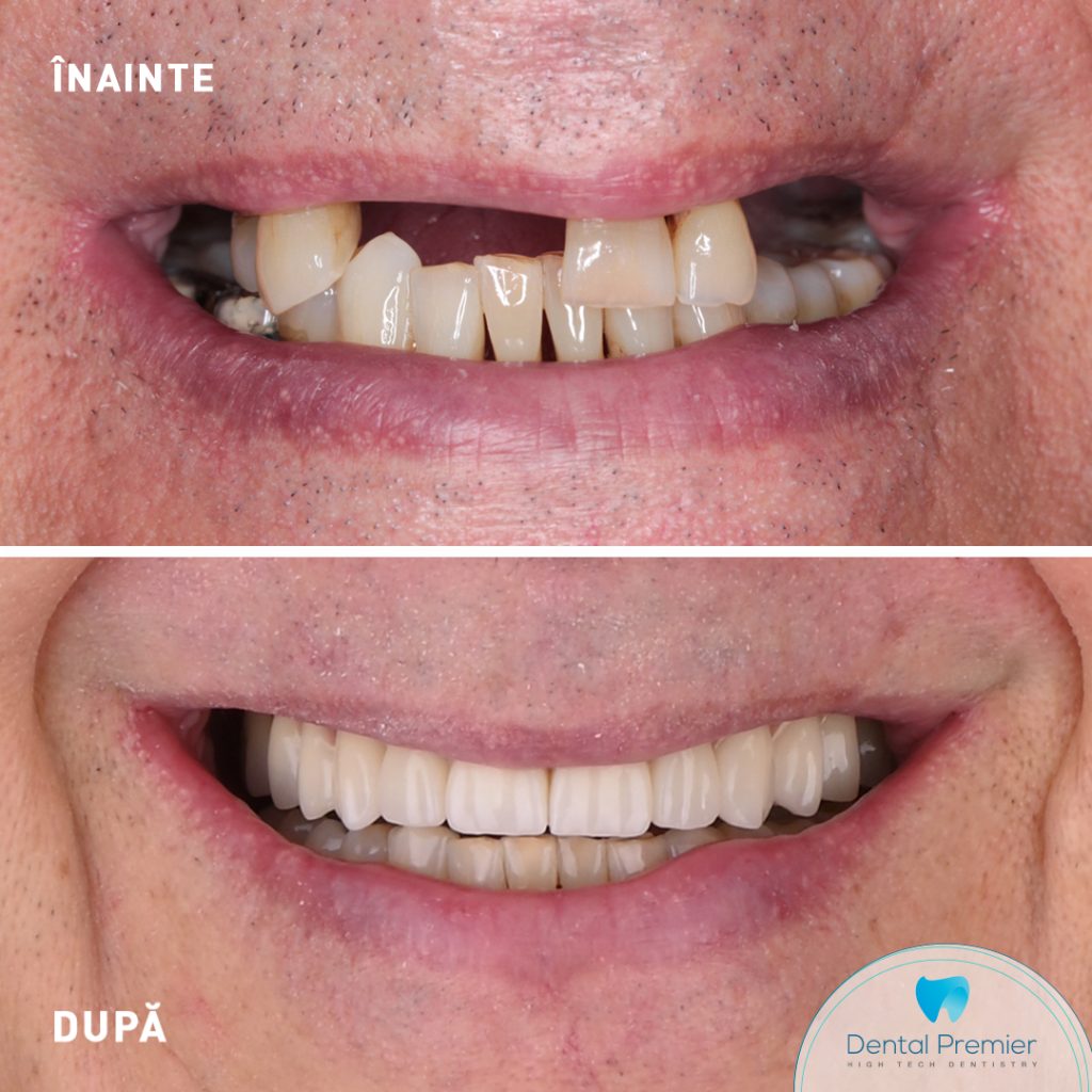 Implanturi dentare All-on-6 si All-on-4 + Dinti Ficsi in 24 ore - Bimaxilar