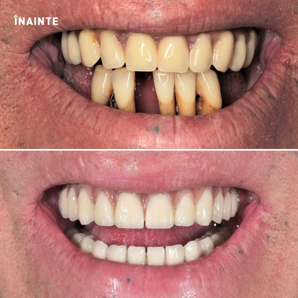 Implanturi rapide All-on-6 si All-on-4 + Dinti Ficsi in 24 de ore - Maxilar si Mandibula