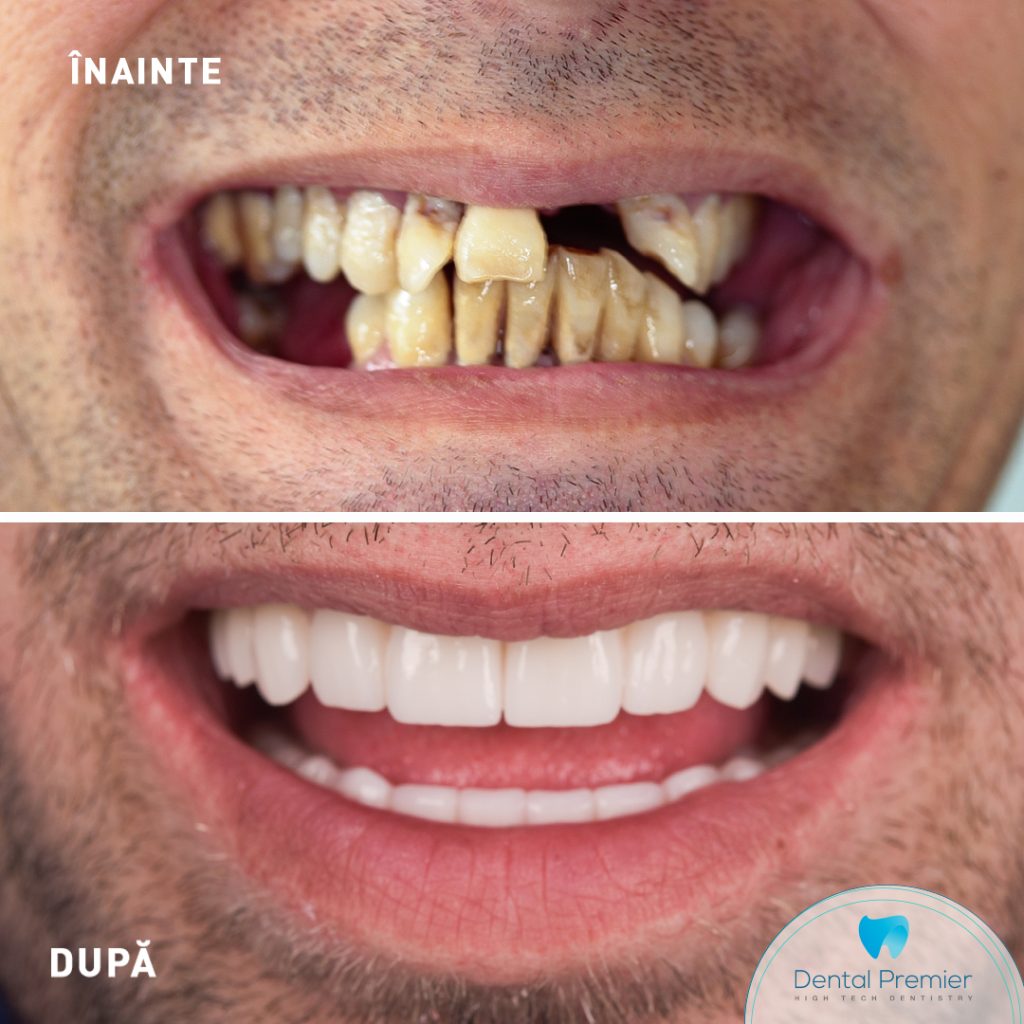 Dinti Ficsi in 24 de ore pe implanturi All-on-6 si All-on-4 - Maxilar si mandibula