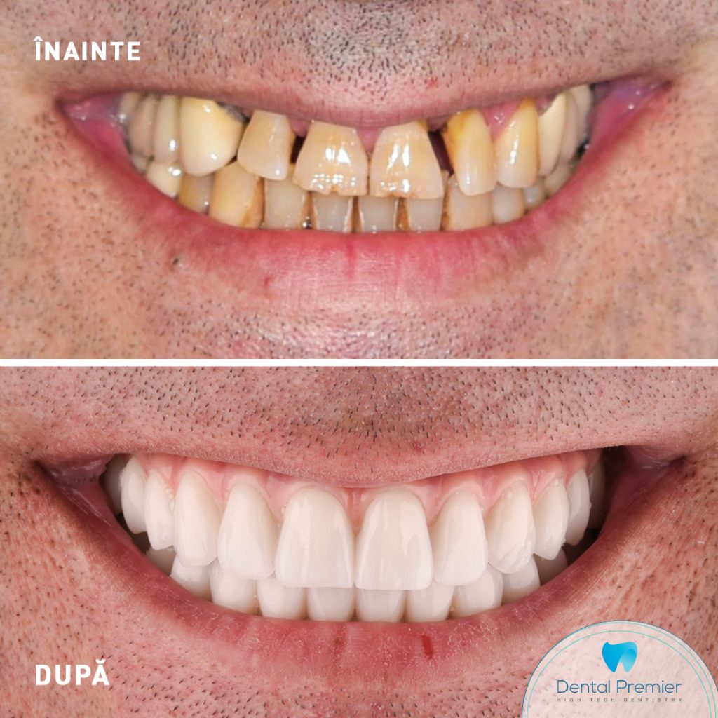 Dantura Fixa in 24 de ore pe implanturi All-on-4 si All-on-6 - maxilar si mandibula