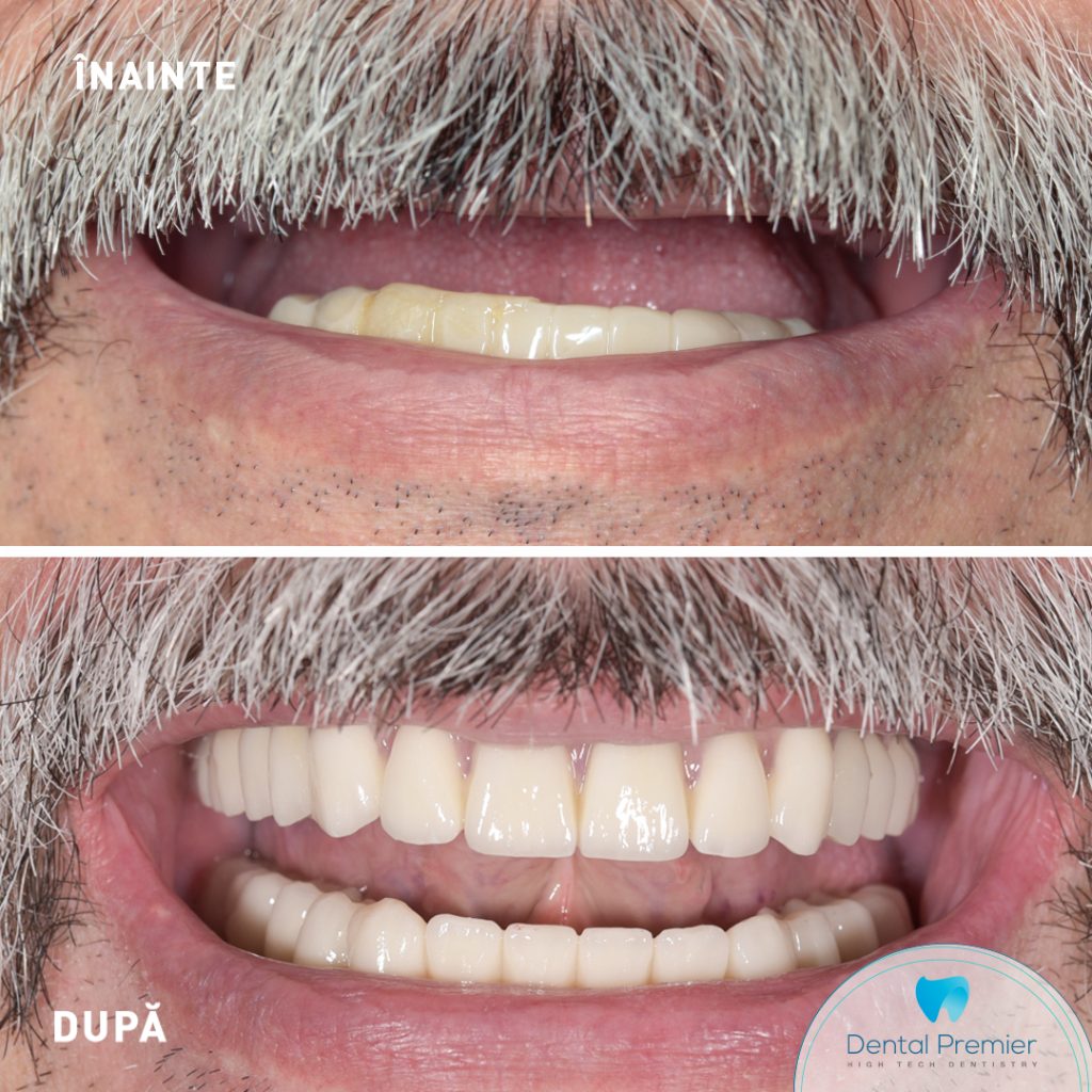 Implanturi si Dantura Fixa in 24 de ore la maxilar si mandibula