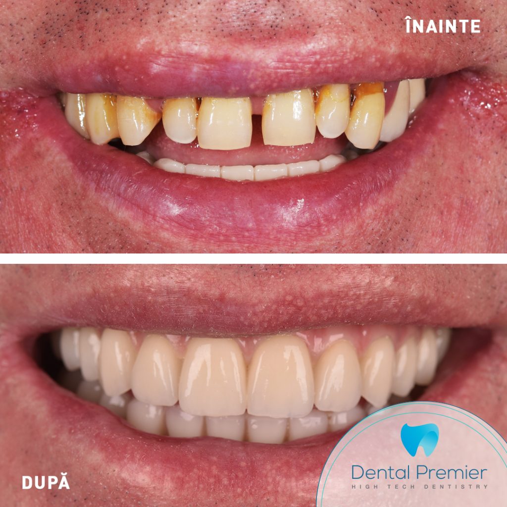 Implanturi si dinti ficsi in 24 de ore - Fast and Fixed Bredent