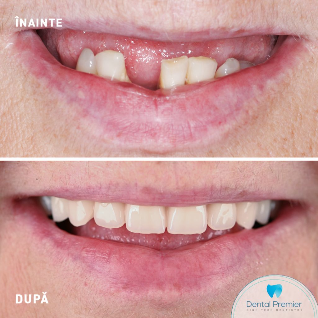 Implanturi si dinti ficsi in 24 ore la maxilar si mandibula