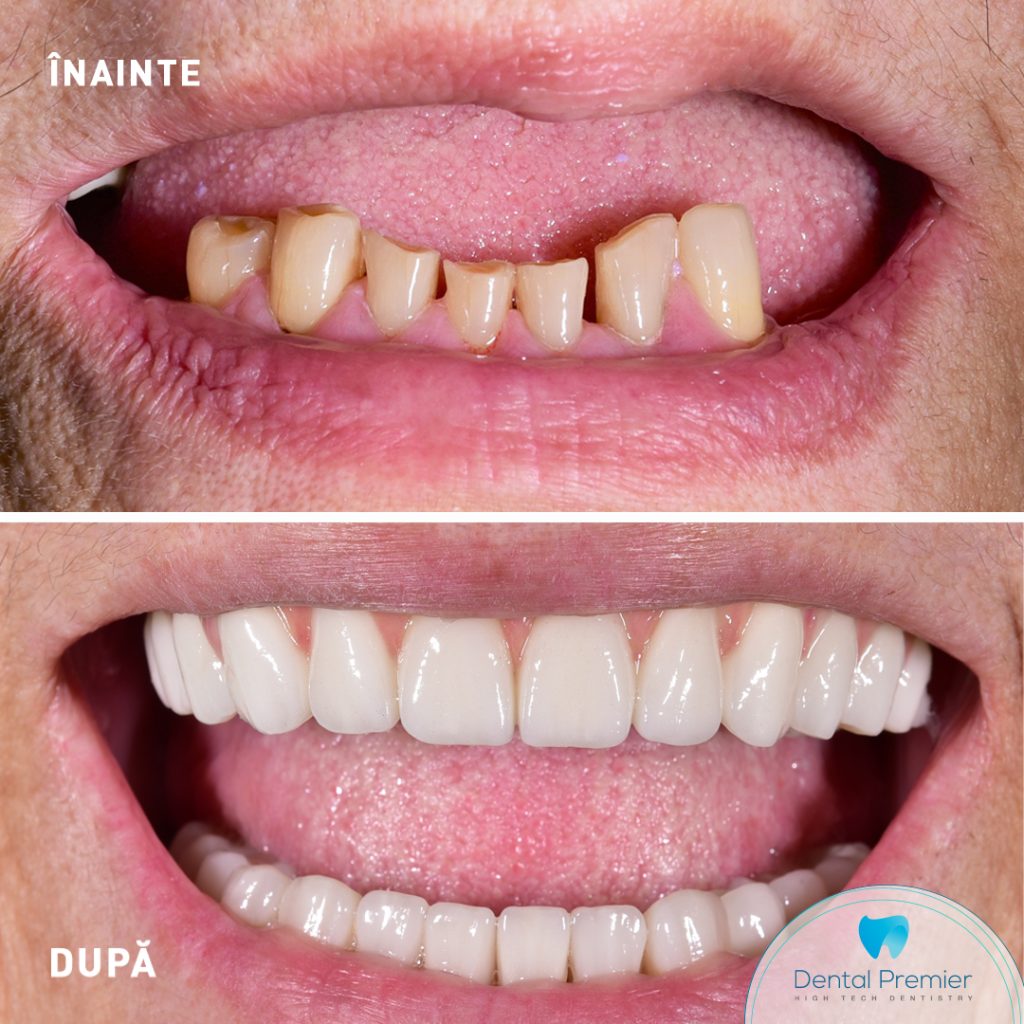 Pacienta restaurare totala prin tehnica implanturi si dinti ficsi in 24 ore - proteze dentare fixe cu 4 si 6 implanturi