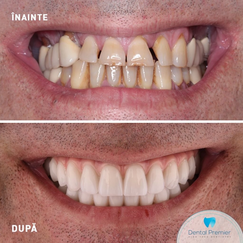 Pacient cu reabilitare orala totala cu sistemul implanturi si dantura fixa in 24 de ore - maxilar si mandibula