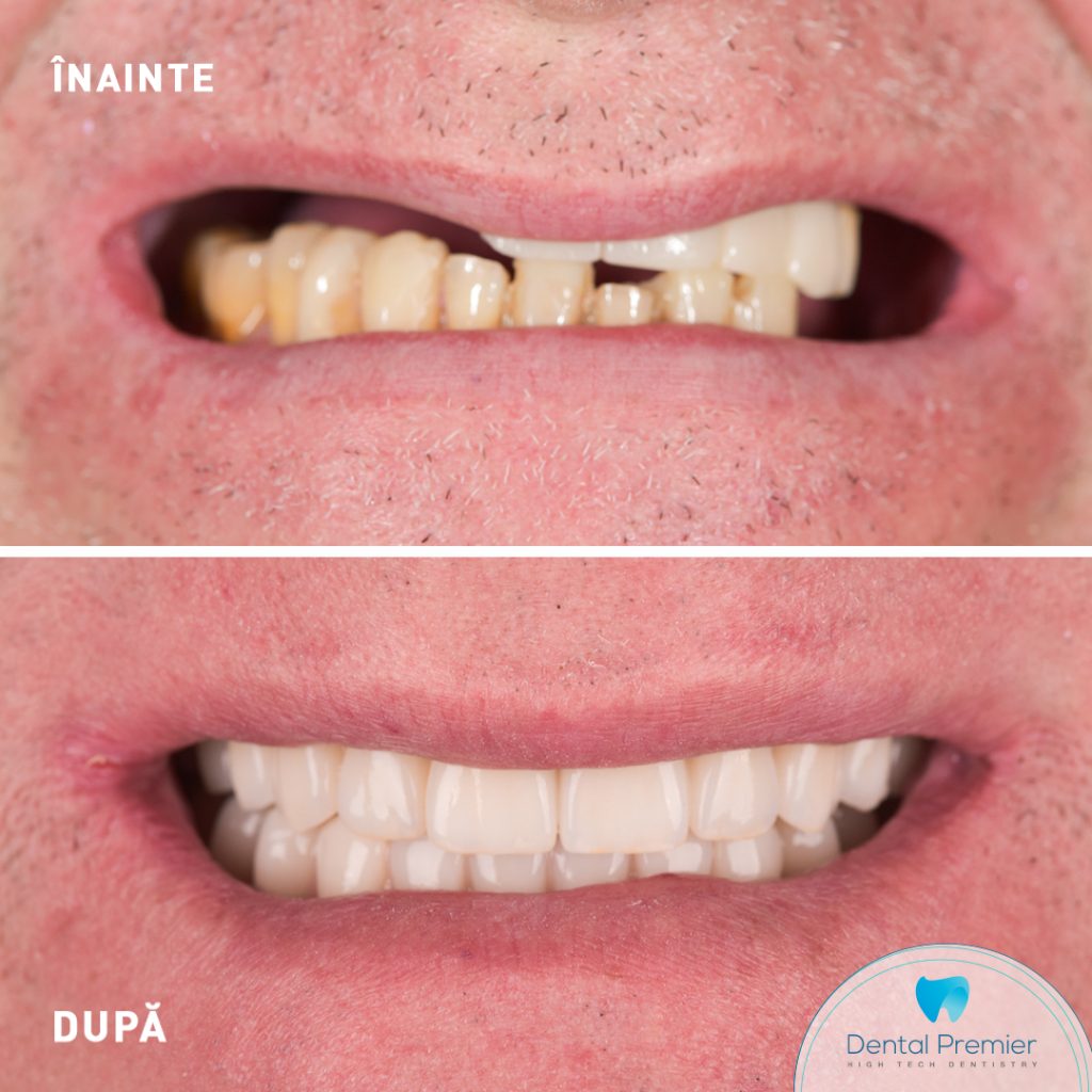 Pacient cu dubla reabilitare la maxilar si mandibula prin tehnica implanturi si dinti ficsi in 24 ore