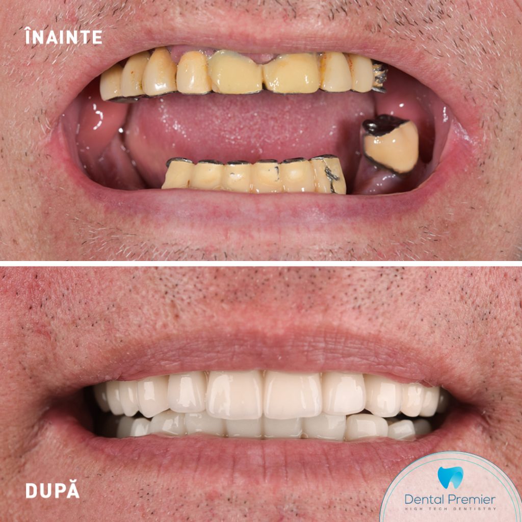 Pacient dantura fixa in 24 de ore - proteze fixe pe implanturi All-on-4 si All-on-6