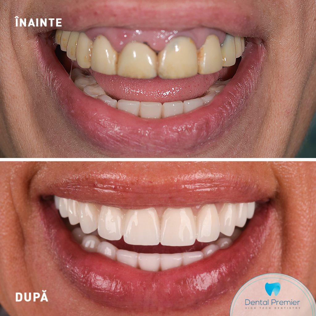 Pacienta dinti ficsi in 24 de ore - proteze fixe pe 4 si 6 implanturi Fast and Fixed Bredent