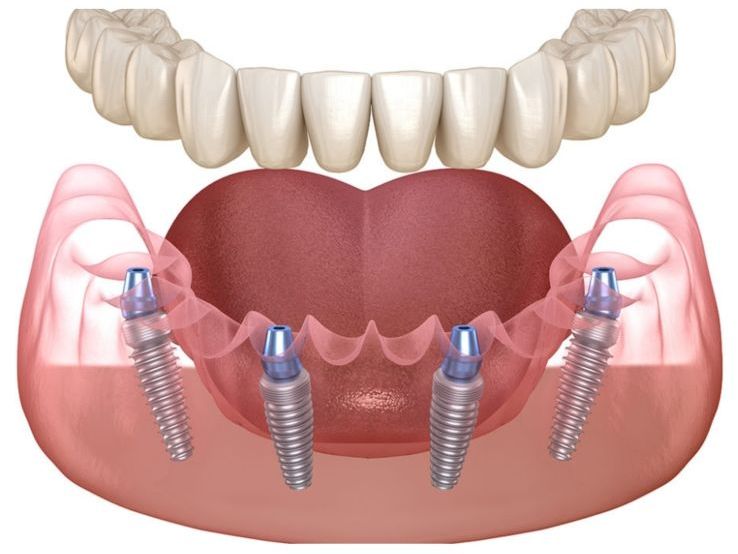 Implant dentar All-on-4 la mandibula
