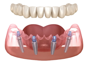 Proteza dentara fixa cu 4 implanturi All-on-4