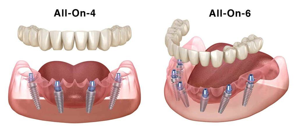Proteze fixe pe implant dentar All-on-4 si All-on-6: pret si tipuri