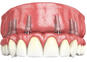 Lucrare fixa pe 6 implanturi la maxilar