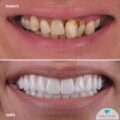 Lucrare fixa pe 6 implanturi All-on-6