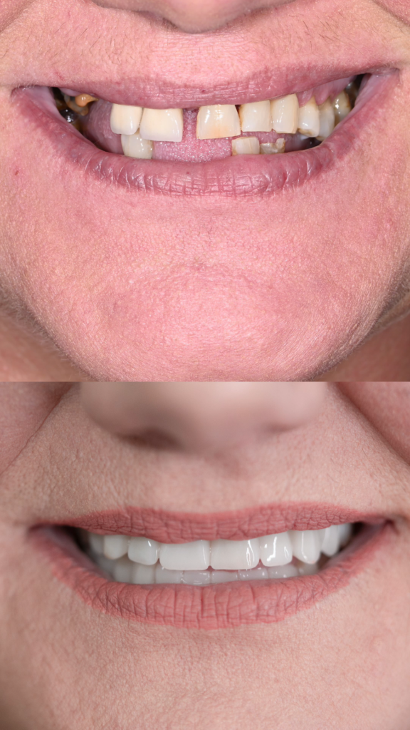 Inainte si dupa lucrari fixe pe implanturi dentare All-on-4 si All-on-6