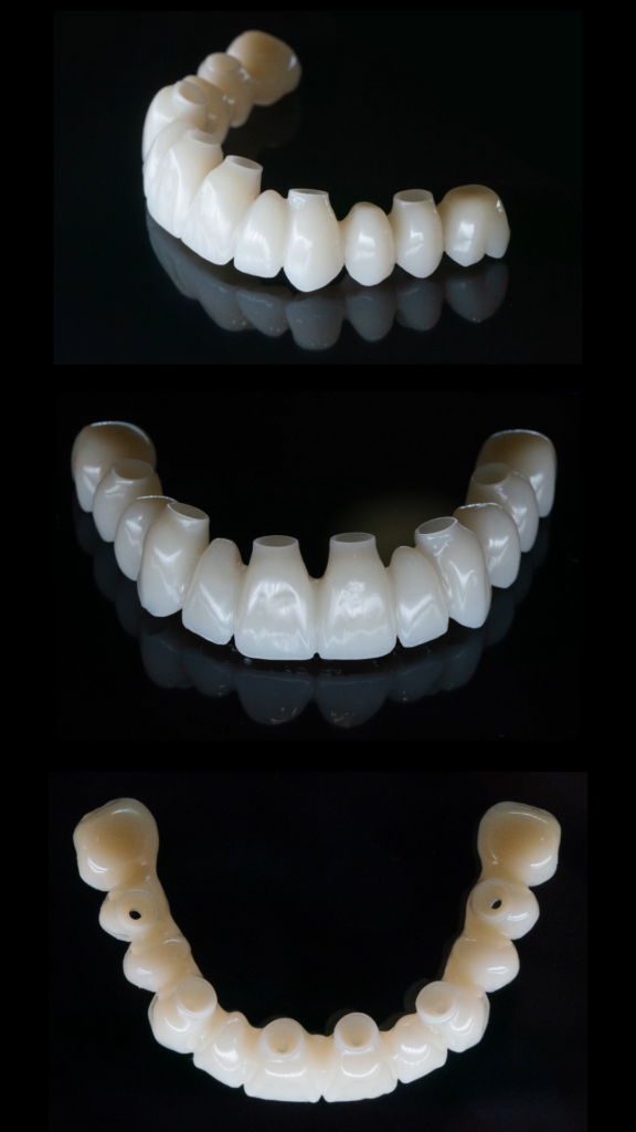 Lucrare dentara fixa provizorie