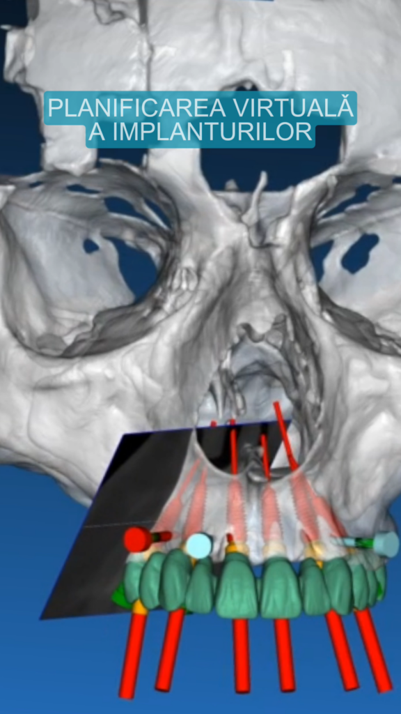 Planificarea virtuala a implanturilor