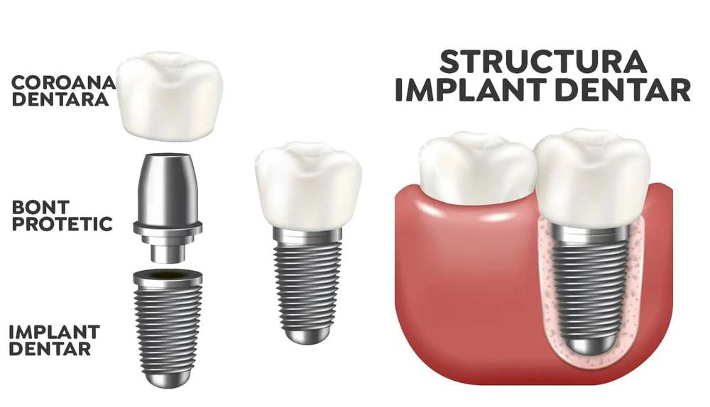 Implant dentar Implant dentar procedura