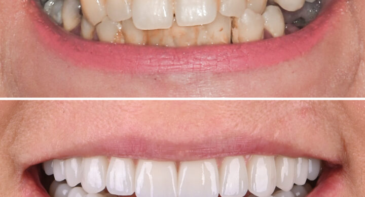 Dantura fixa pe implanturi Straumann Pro Arch All-on-4 si All-on-6